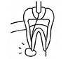 Root Canal
